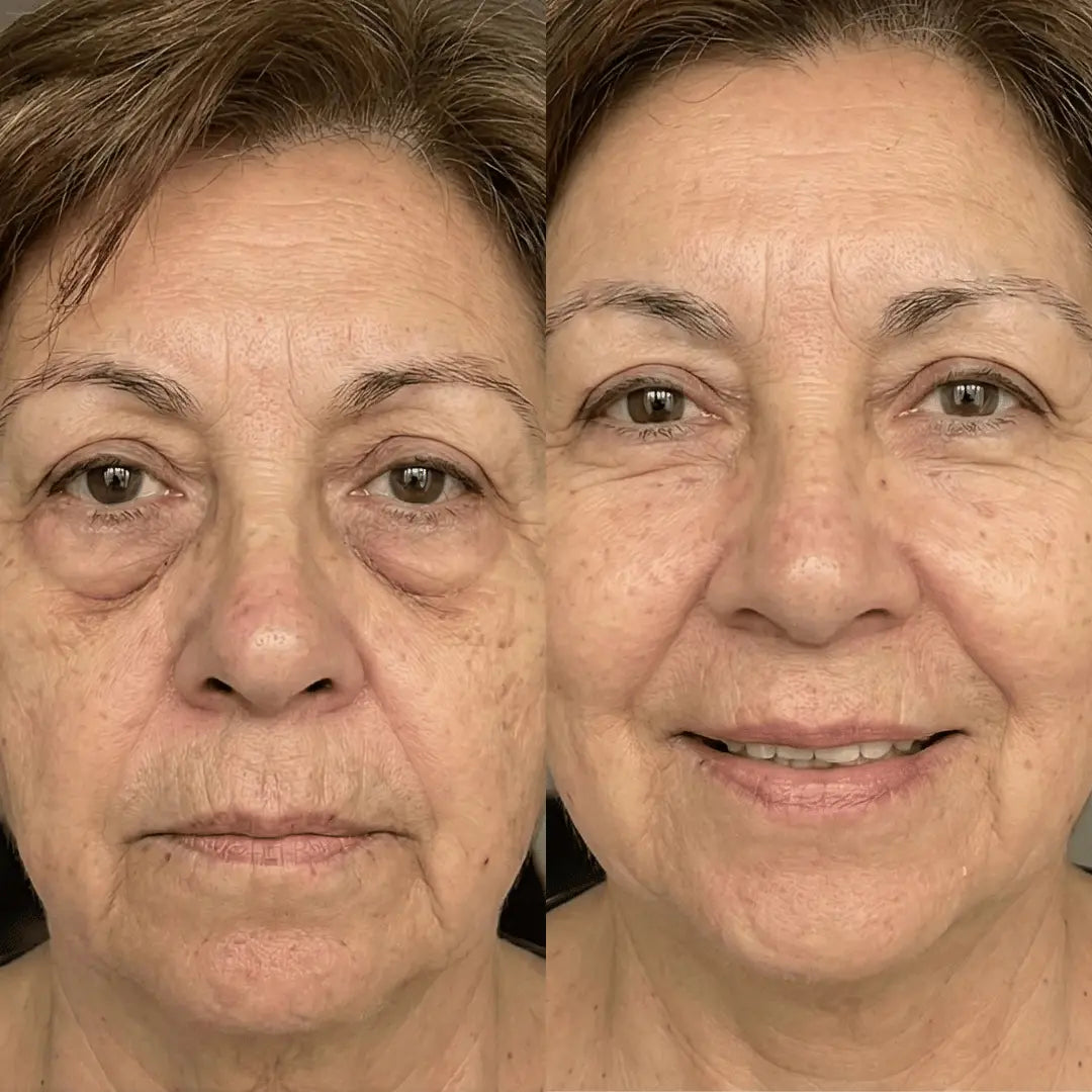 DermiaEyes® Reduce bolsas y ojeras en solo 10 minutos al día